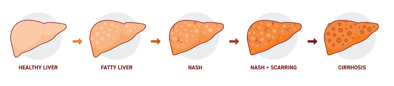 The progression of liver cancer