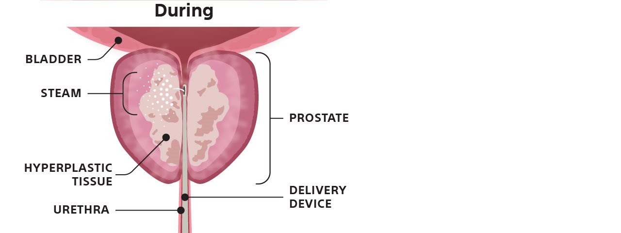 Illustration of prostate during