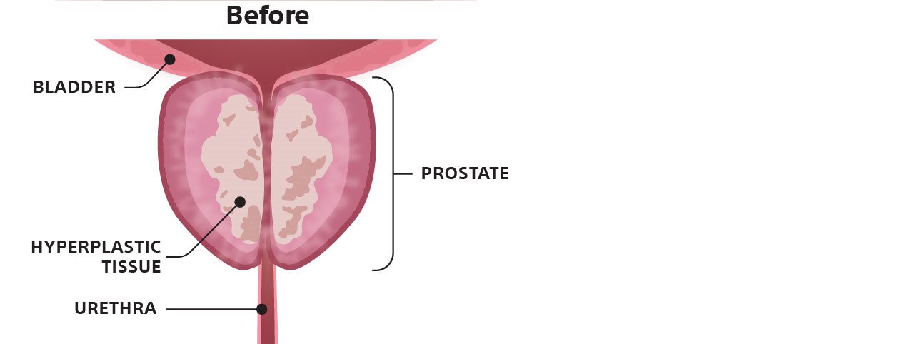 Illustration of prostate before