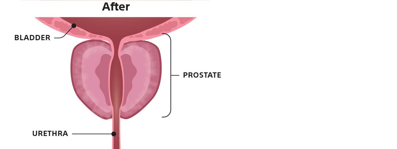 Illustration of prostate after